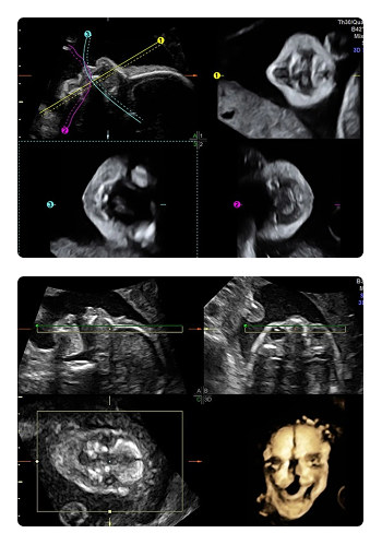 Fetal face and spine ultrasound workshop CUSP 2026 Chennai prenatal imaging