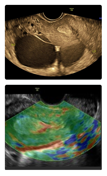 Gynaecological ultrasound workshop Chennai 2026 pelvic imaging ovarian lesions fibroids endometriosis training