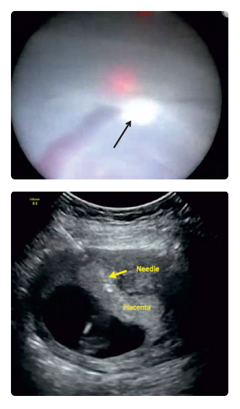 Fetal Intervention Workshop Chennai 2026 ultrasound guided procedures training