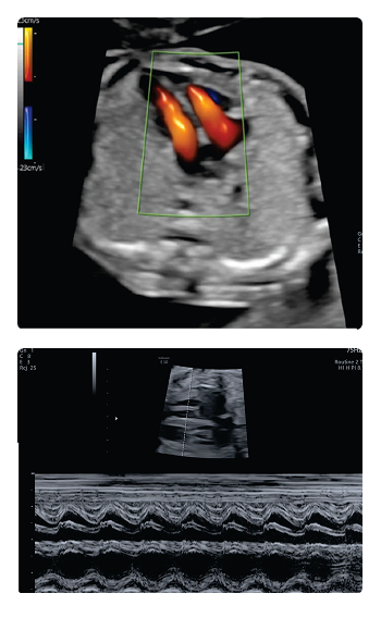 Fetal echocardiography workshop Chennai 2026 ISUOG fetal heart ultrasound training